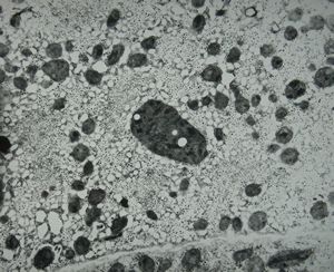 M,15y. | Wilson disease - megamitochondria M,15y. | Wilson disease - megamitochondria
